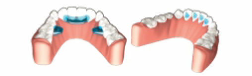 Incorporate tongue crib or tongue elevator
