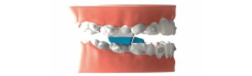 A6 Mandibular advancement blocks