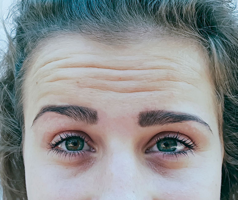 Forehead Wrinkles before treatment