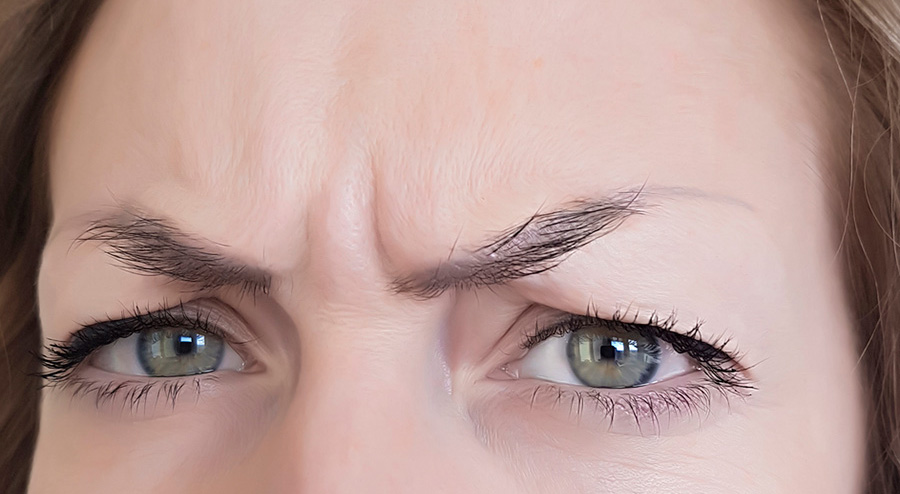 Galbella frown lines before treatment