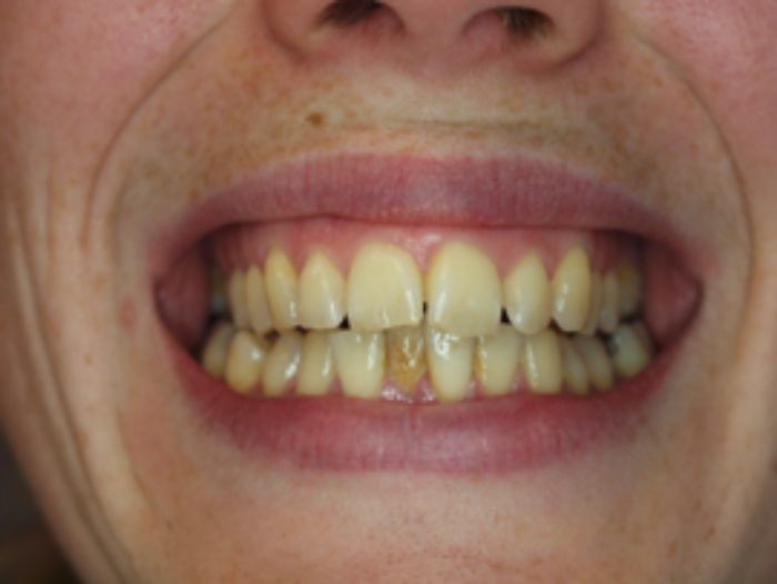 Before 6 Month Smiles Treatment