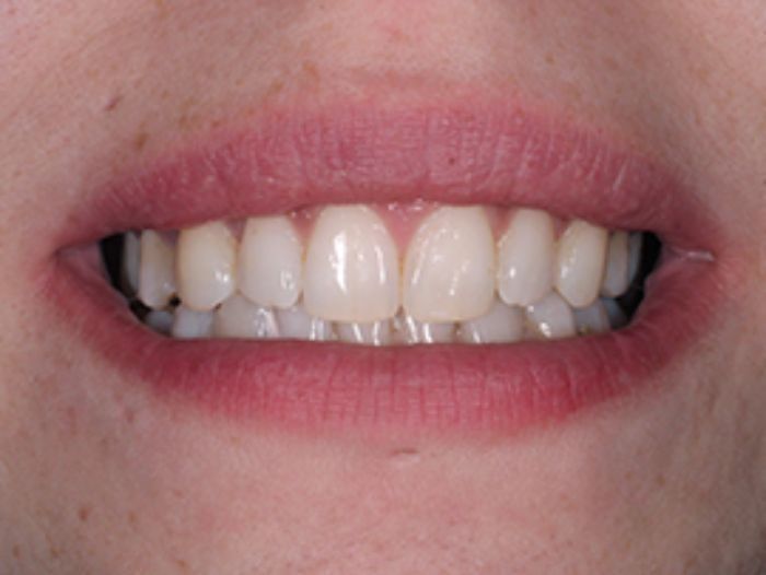 After Invisalign Treatment