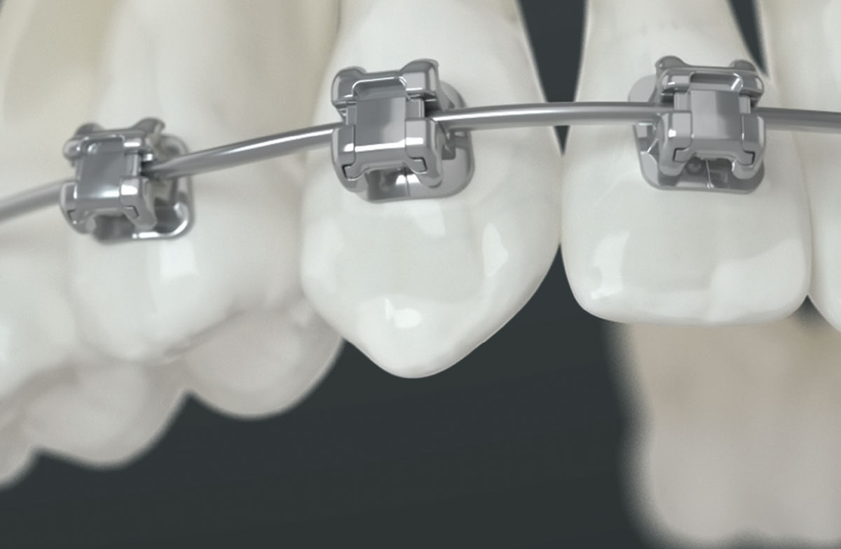 Damon Ultima Braces
