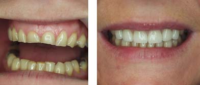 Before and After Veneers Treatment