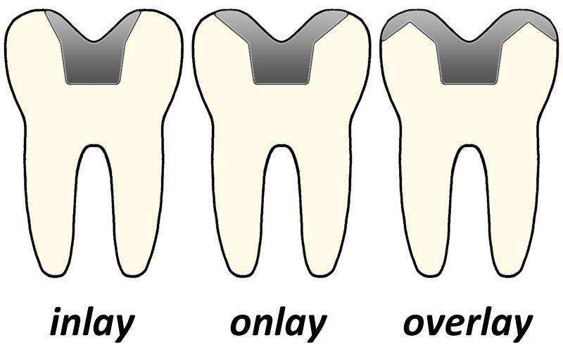 inlay