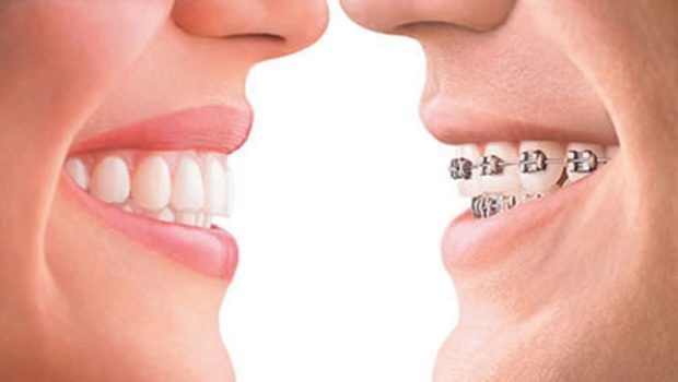 Invisalign Cork