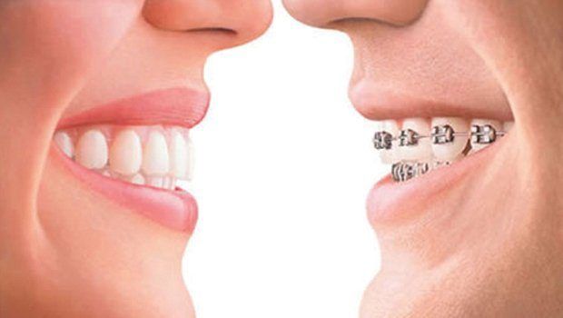 invisalign cork