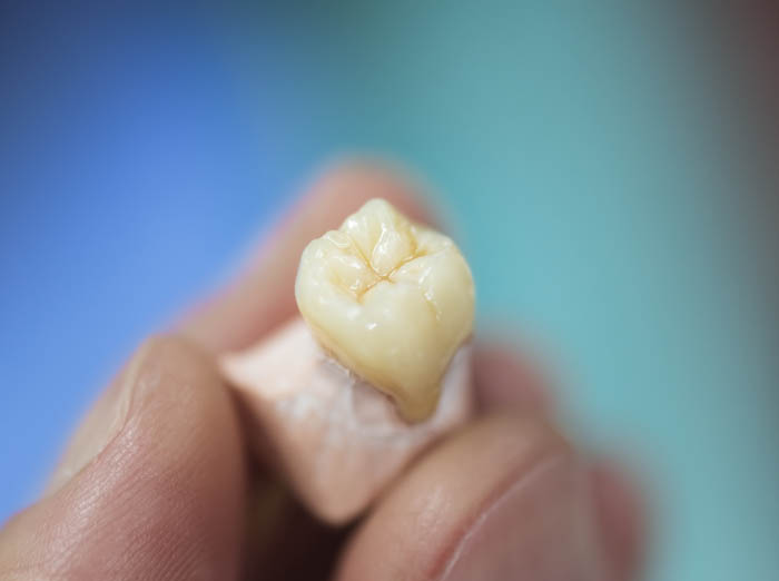 Dental Crowns Cork