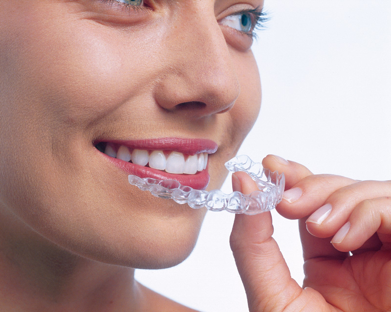 Invisalign Braces Cork